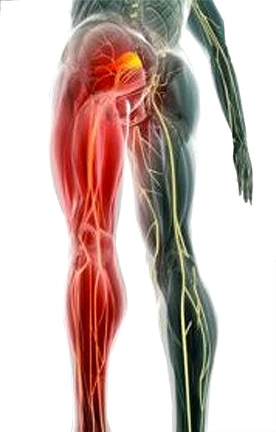 Sciatica