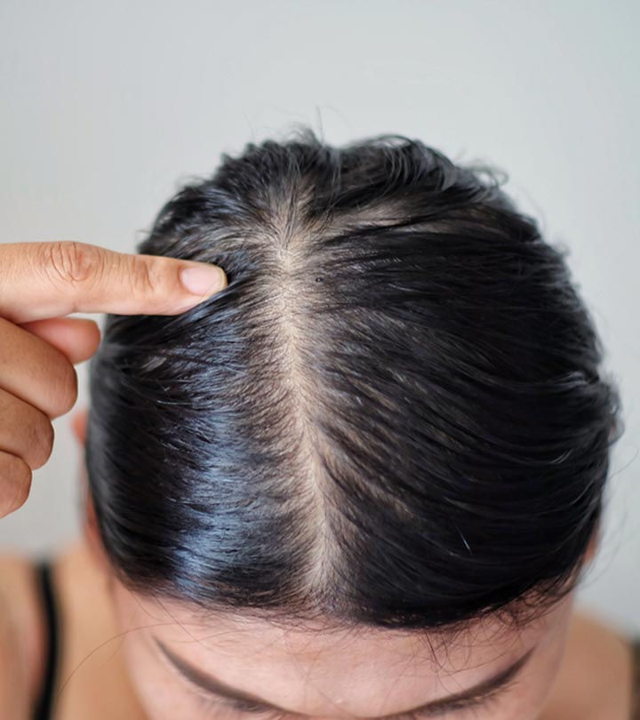 Hairloss