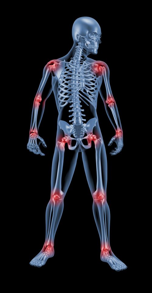 Arthritis