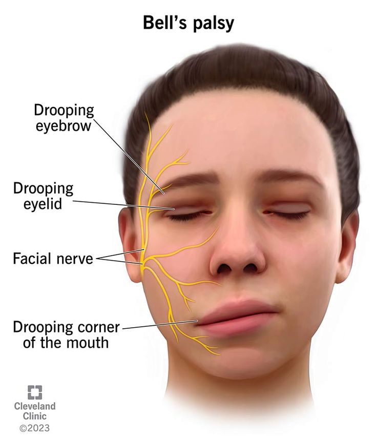 Facial palsy