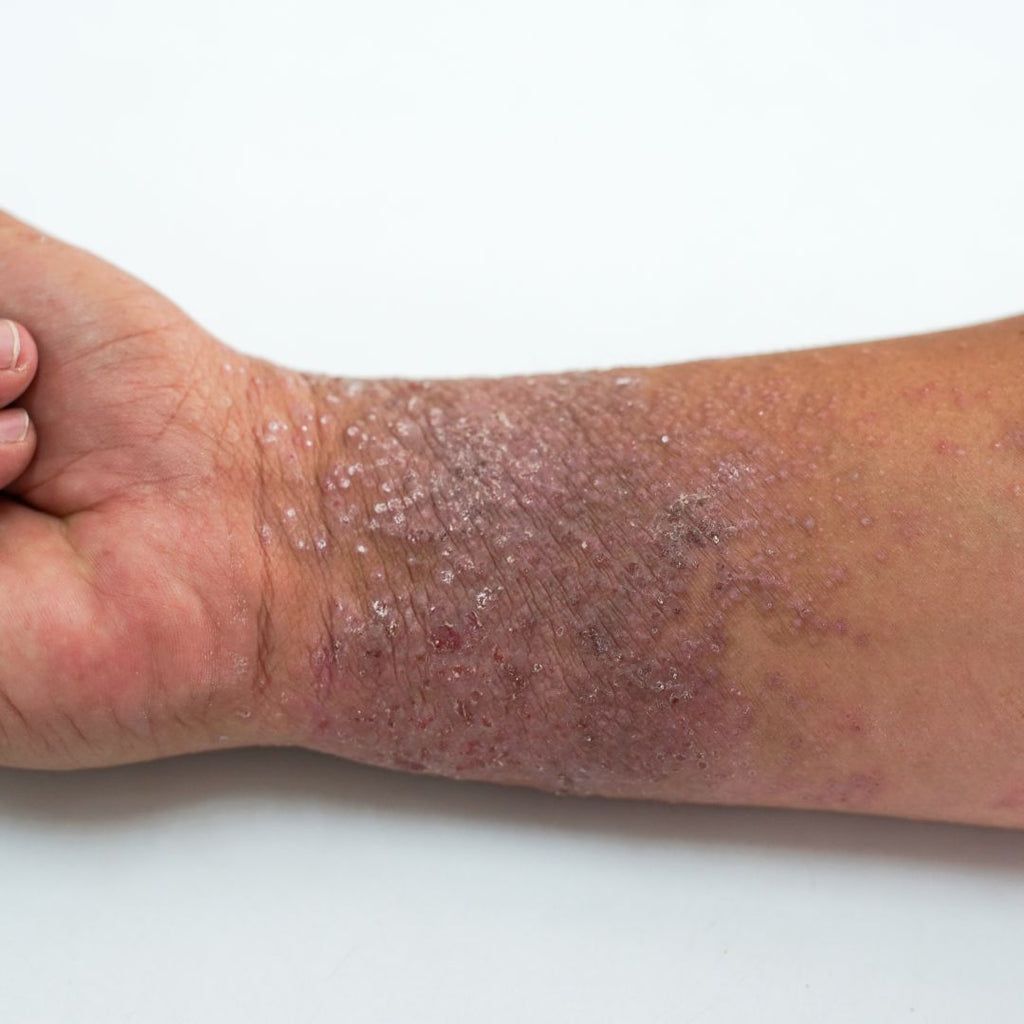 Eczema